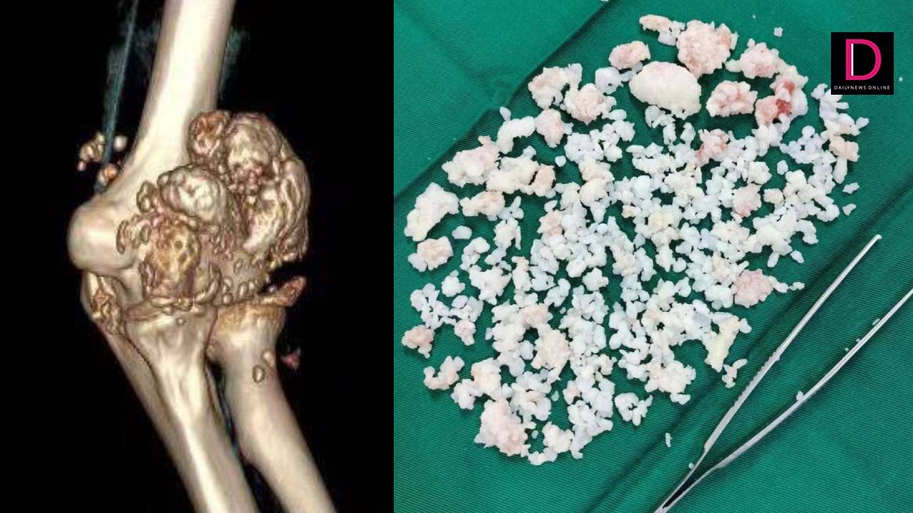 Warning to “mobile phone addicts”!  Doctors remove thousands of plaques from young patient’s elbow  Caused by playing on the phone 10 hours a day | Daily News